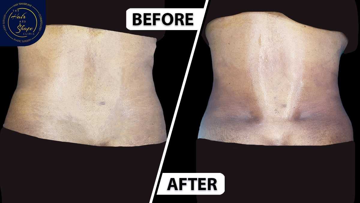 Back Liposuction result14